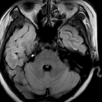 郑州大学五附院医学影像科 PETCT 开展难治性癫痫定位定性显像新技术