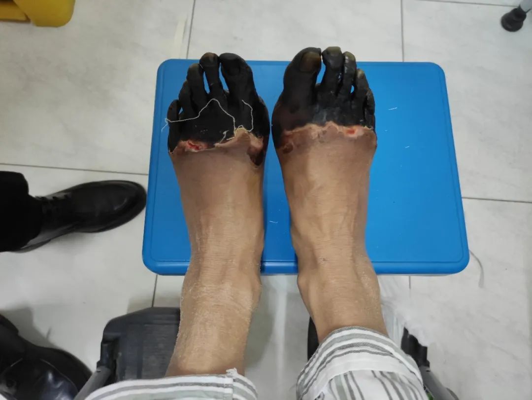 双脚被冻成紫黑色！西安医学院一附院三次手术为其保留「残足长度」