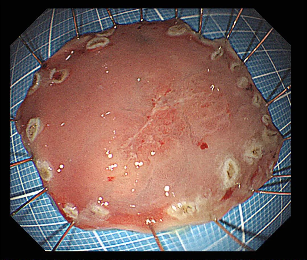 年过五十，第一次胃肠镜体验，竟意外查出胃早癌