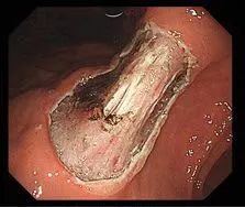 年过五十，第一次胃肠镜体验，竟意外查出胃早癌