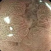 年过五十，第一次胃肠镜体验，竟意外查出胃早癌