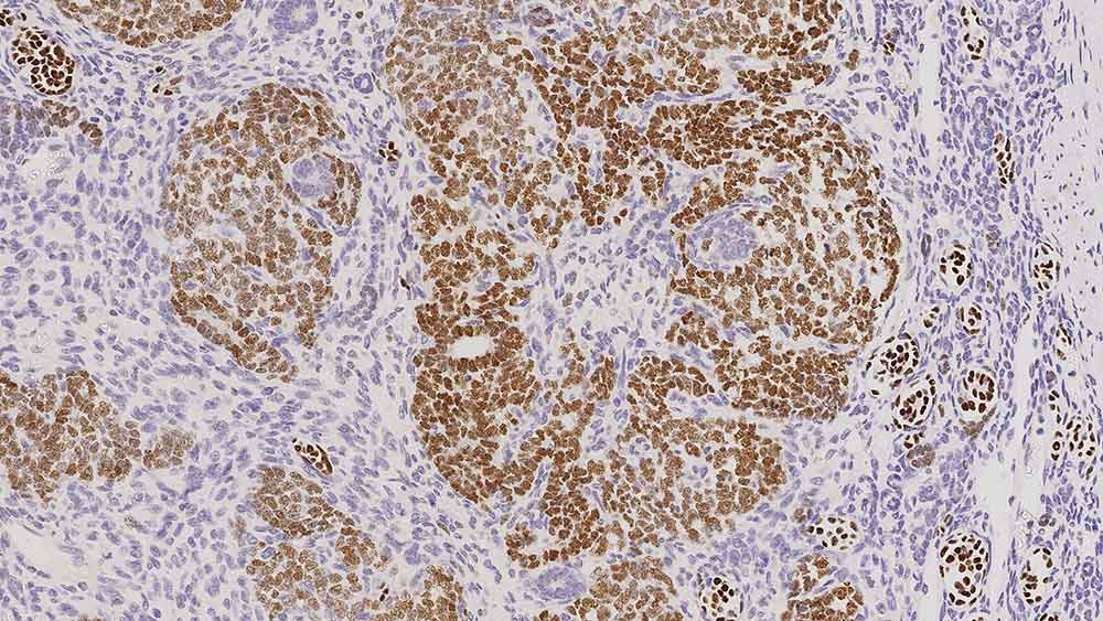 Wilms Tumor 1 antibody [WT49]