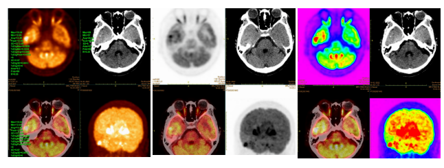 郑州大学五附院医学影像科 PETCT 开展难治性癫痫定位定性显像新技术