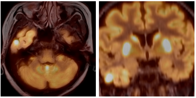 郑州大学五附院医学影像科 PETCT 开展难治性癫痫定位定性显像新技术
