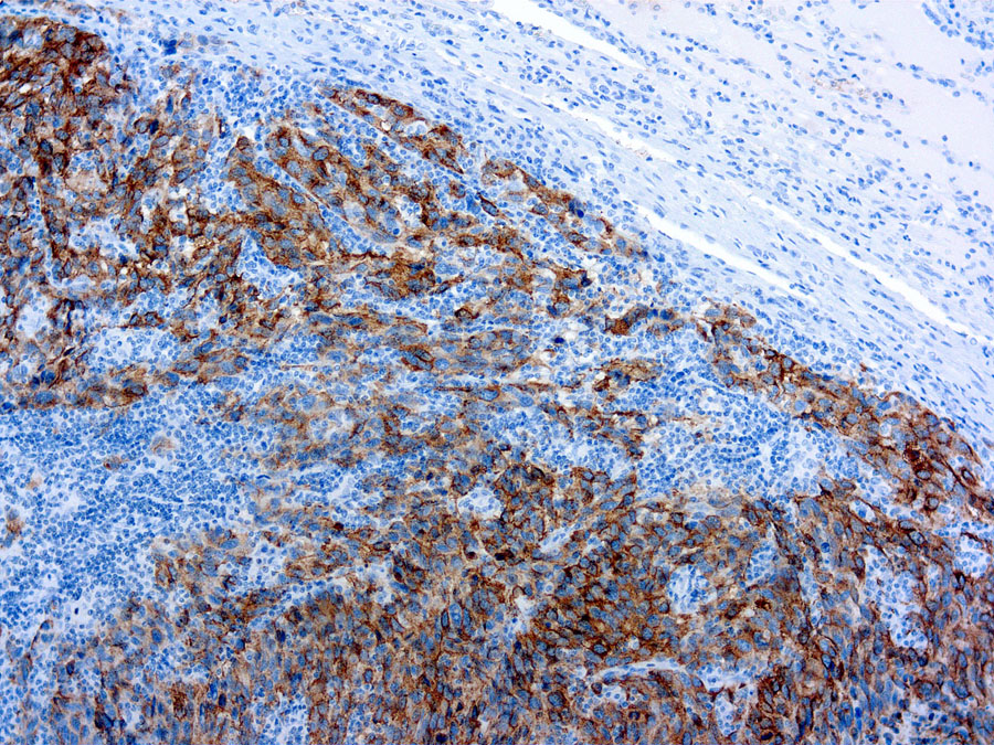 Melanoma antibody [HMB45] (ready-to-use)