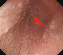 70 岁嗲嗲食不能下咽 10 多年，食管内打条「隧道」，好了！