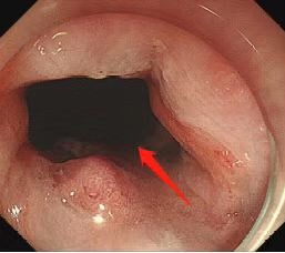 70 岁嗲嗲食不能下咽 10 多年，食管内打条「隧道」，好了！