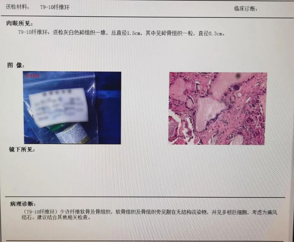 高尚病例：无处不在的痛风石