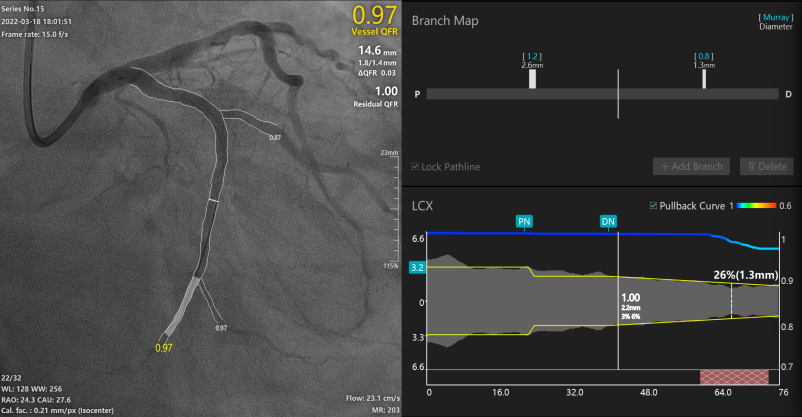 桂林医学院附属医院心血管内科二病区采用 QFR 精准指导冠脉支架植入