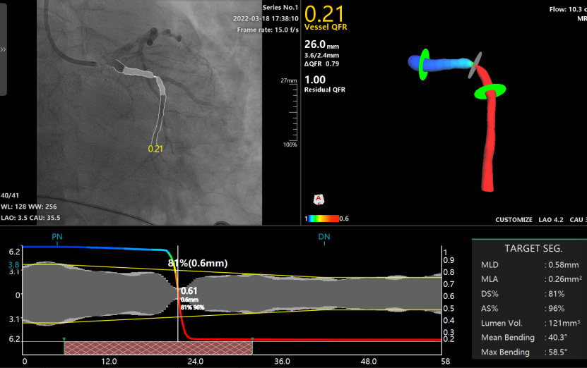 桂林医学院附属医院心血管内科二病区采用 QFR 精准指导冠脉支架植入