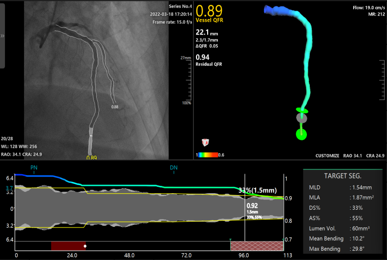 桂林医学院附属医院心血管内科二病区采用 QFR 精准指导冠脉支架植入