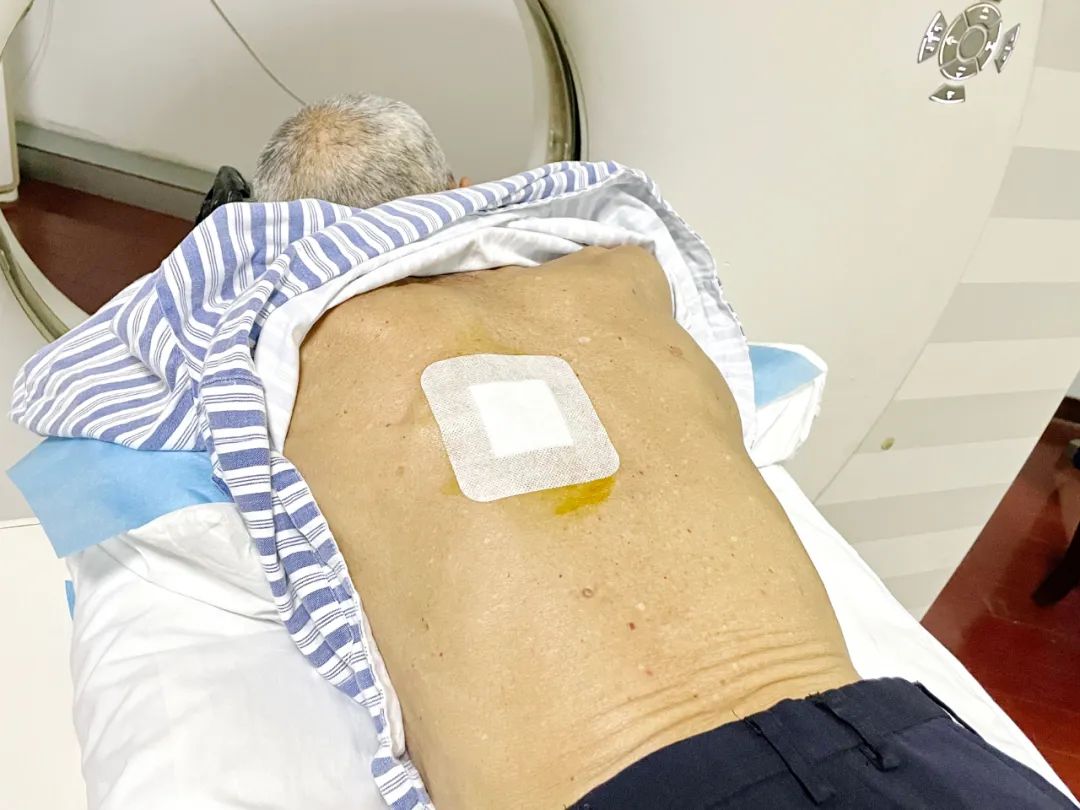 反复咳嗽咳痰，CT 引导下经皮肺穿刺活检术精准找出「元凶」