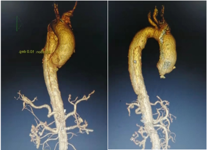 71 岁老人突发主动脉夹层命悬一线 桂医附院 MDT 团队成功拆「弹」