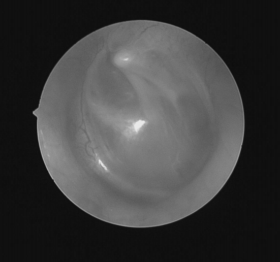 南昌大学二附院耳鼻咽喉头颈外科完成一例鼻内镜下中颅窝底表皮样囊肿切除术