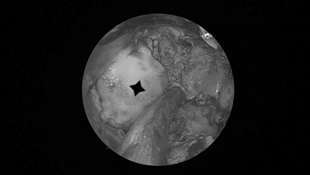 南昌大学二附院耳鼻咽喉头颈外科完成一例鼻内镜下中颅窝底表皮样囊肿切除术