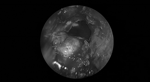南昌大学二附院耳鼻咽喉头颈外科完成一例鼻内镜下中颅窝底表皮样囊肿切除术