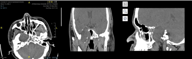 南昌大学二附院耳鼻咽喉头颈外科完成一例鼻内镜下中颅窝底表皮样囊肿切除术