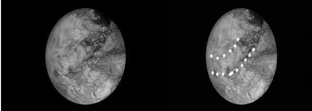 南昌大学二附院耳鼻咽喉头颈外科完成一例鼻内镜下中颅窝底表皮样囊肿切除术