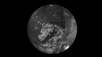 南昌大学二附院耳鼻咽喉头颈外科完成一例鼻内镜下中颅窝底表皮样囊肿切除术