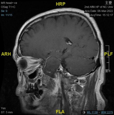 南昌大学二附院耳鼻咽喉头颈外科完成一例鼻内镜下中颅窝底表皮样囊肿切除术