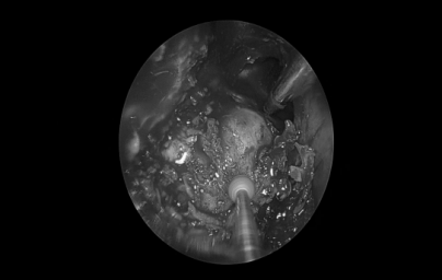 南昌大学二附院耳鼻咽喉头颈外科完成一例鼻内镜下中颅窝底表皮样囊肿切除术