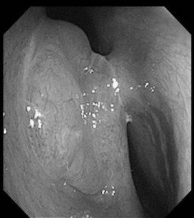南昌大学二附院耳鼻咽喉头颈外科完成一例鼻内镜下中颅窝底表皮样囊肿切除术
