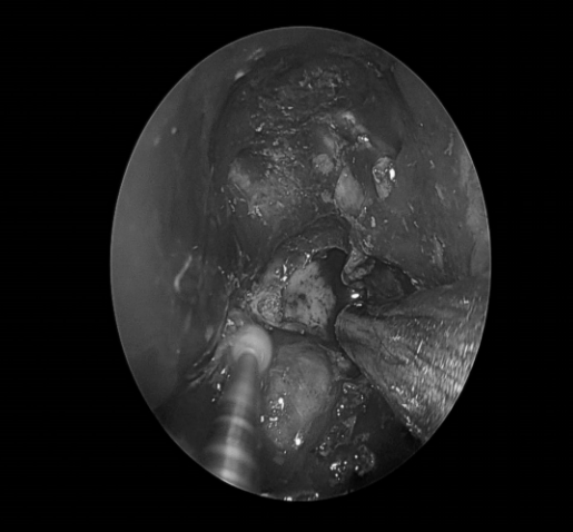 南昌大学二附院耳鼻咽喉头颈外科完成一例鼻内镜下中颅窝底表皮样囊肿切除术