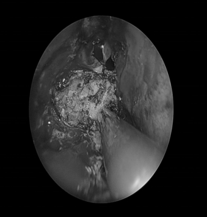 南昌大学二附院耳鼻咽喉头颈外科完成一例鼻内镜下中颅窝底表皮样囊肿切除术