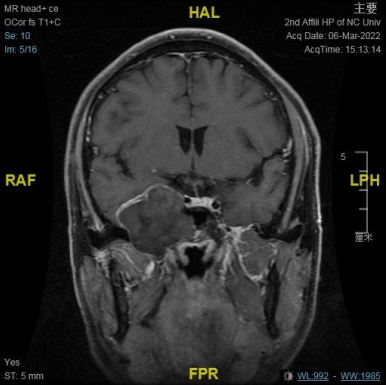 南昌大学二附院耳鼻咽喉头颈外科完成一例鼻内镜下中颅窝底表皮样囊肿切除术