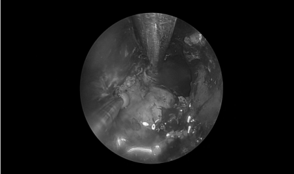 南昌大学二附院耳鼻咽喉头颈外科完成一例鼻内镜下中颅窝底表皮样囊肿切除术