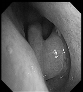 南昌大学二附院耳鼻咽喉头颈外科完成一例鼻内镜下中颅窝底表皮样囊肿切除术