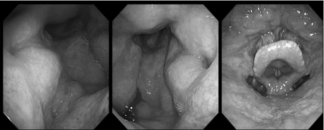 南昌大学二附院耳鼻咽喉头颈外科完成一例鼻内镜下中颅窝底表皮样囊肿切除术