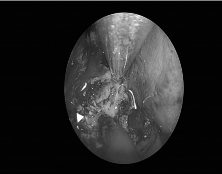 南昌大学二附院耳鼻咽喉头颈外科完成一例鼻内镜下中颅窝底表皮样囊肿切除术