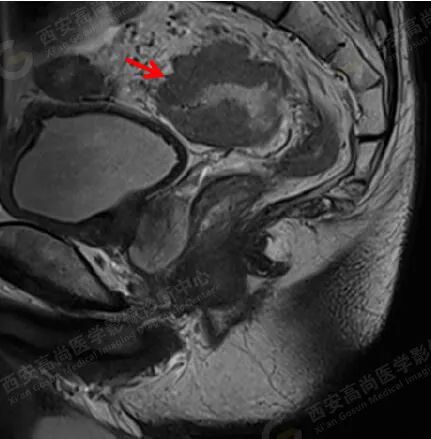 高尚病例：影像视角-直肠癌病例、分期