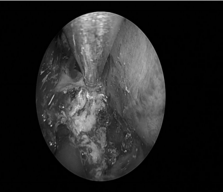 南昌大学二附院耳鼻咽喉头颈外科完成一例鼻内镜下中颅窝底表皮样囊肿切除术