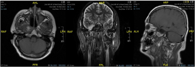 南昌大学二附院耳鼻咽喉头颈外科完成一例鼻内镜下中颅窝底表皮样囊肿切除术