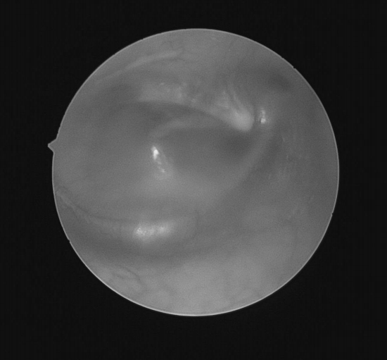 南昌大学二附院耳鼻咽喉头颈外科完成一例鼻内镜下中颅窝底表皮样囊肿切除术