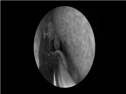 南昌大学二附院耳鼻咽喉头颈外科完成一例鼻内镜下中颅窝底表皮样囊肿切除术