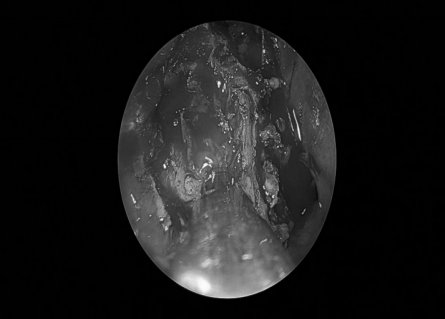 南昌大学二附院耳鼻咽喉头颈外科完成一例鼻内镜下中颅窝底表皮样囊肿切除术