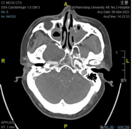 南昌大学二附院耳鼻咽喉头颈外科完成一例鼻内镜下中颅窝底表皮样囊肿切除术