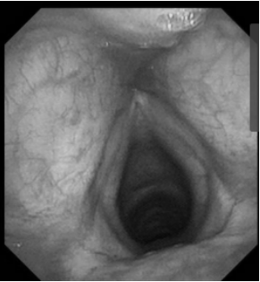 南昌大学二附院耳鼻咽喉头颈外科完成一例鼻内镜下中颅窝底表皮样囊肿切除术