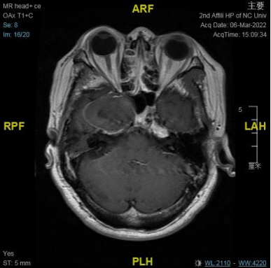 南昌大学二附院耳鼻咽喉头颈外科完成一例鼻内镜下中颅窝底表皮样囊肿切除术