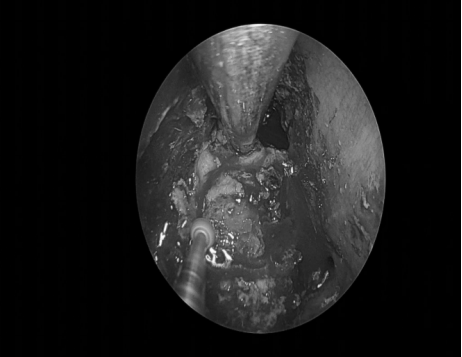 南昌大学二附院耳鼻咽喉头颈外科完成一例鼻内镜下中颅窝底表皮样囊肿切除术