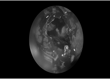 南昌大学二附院耳鼻咽喉头颈外科完成一例鼻内镜下中颅窝底表皮样囊肿切除术