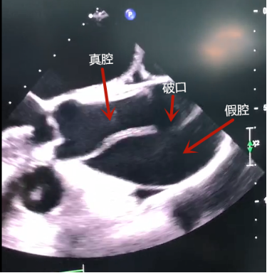 「恐龙血」女子突发主动脉夹层，武汉亚洲心脏病医院 10 小时连夜救治创生命奇迹