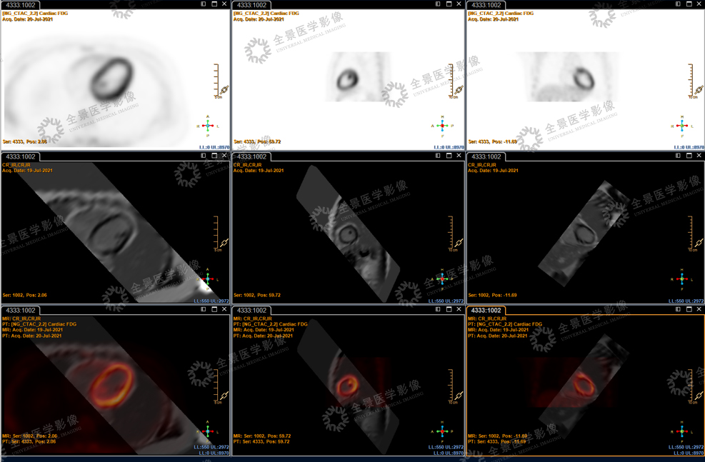 Mr 心肌灌注与pet Ct 心肌代谢显像联合应用评价心肌活性 医院汇 丁香园