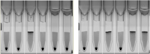 「恐龙血」女子突发主动脉夹层，武汉亚洲心脏病医院 10 小时连夜救治创生命奇迹