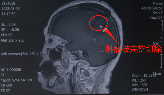 勇闯高龄手术"禁区"！神外为八旬老人「硬核」摘瘤