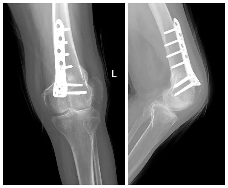 双膝关节外翻畸形截骨矫形术后的康复