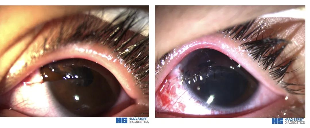 潍坊眼科医院：重视儿童眼外伤，防范于未然